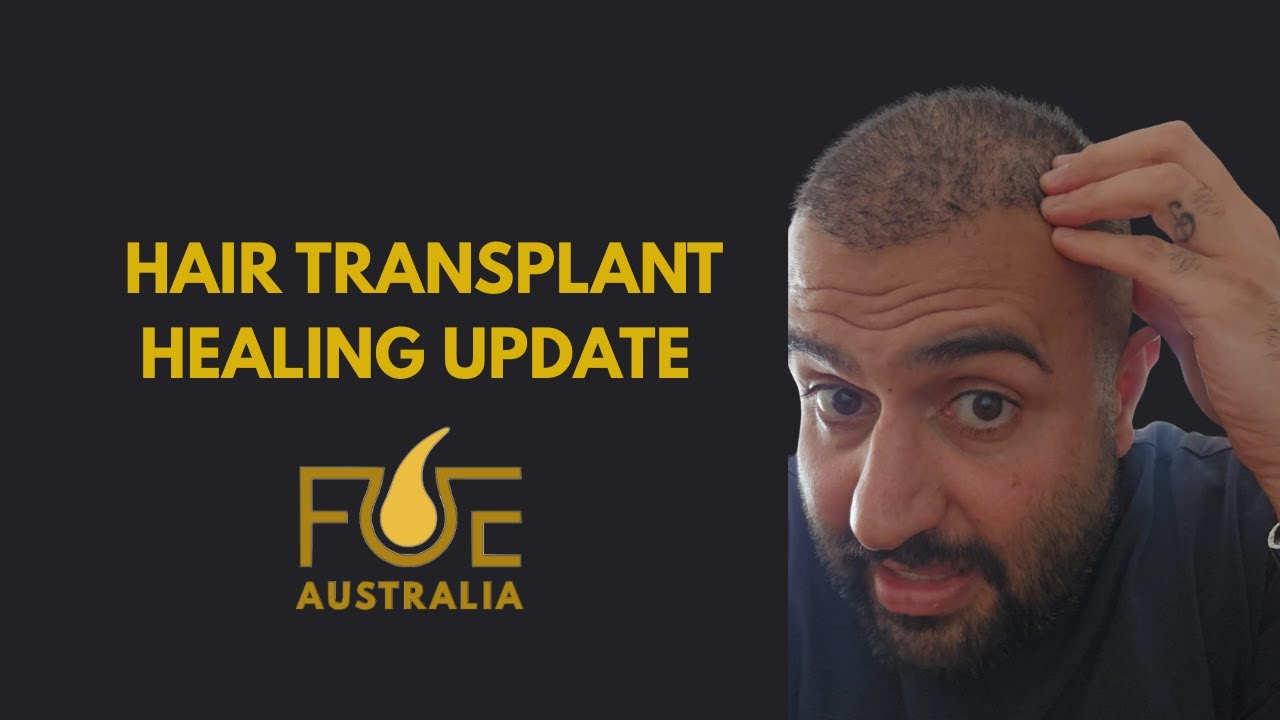 HEALING PROCESS AFTER HAIR TRANSPLANT | FUE AUSTRALIA