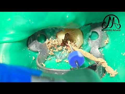 How To Remove Gutta-Percha Easily During Root Canal Retreatment Cases? | Easy Gutta-Percha Removal