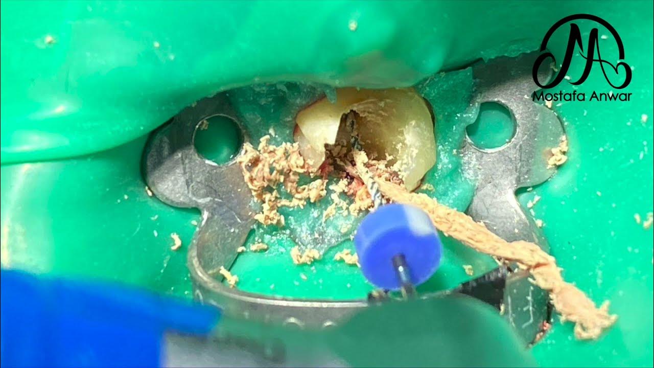 How To Remove GuttaPercha Easily During Root Canal Retreatment Cases