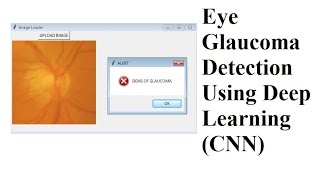EYE GLAUCOMA DETECTION USING DEEP LEARNING