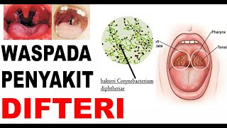 DIFTERI, Definisi, Gejala, Penyebab, Pengobatan, Komplikasi dan Pencegahan