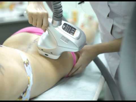 Лазерная эпиляция