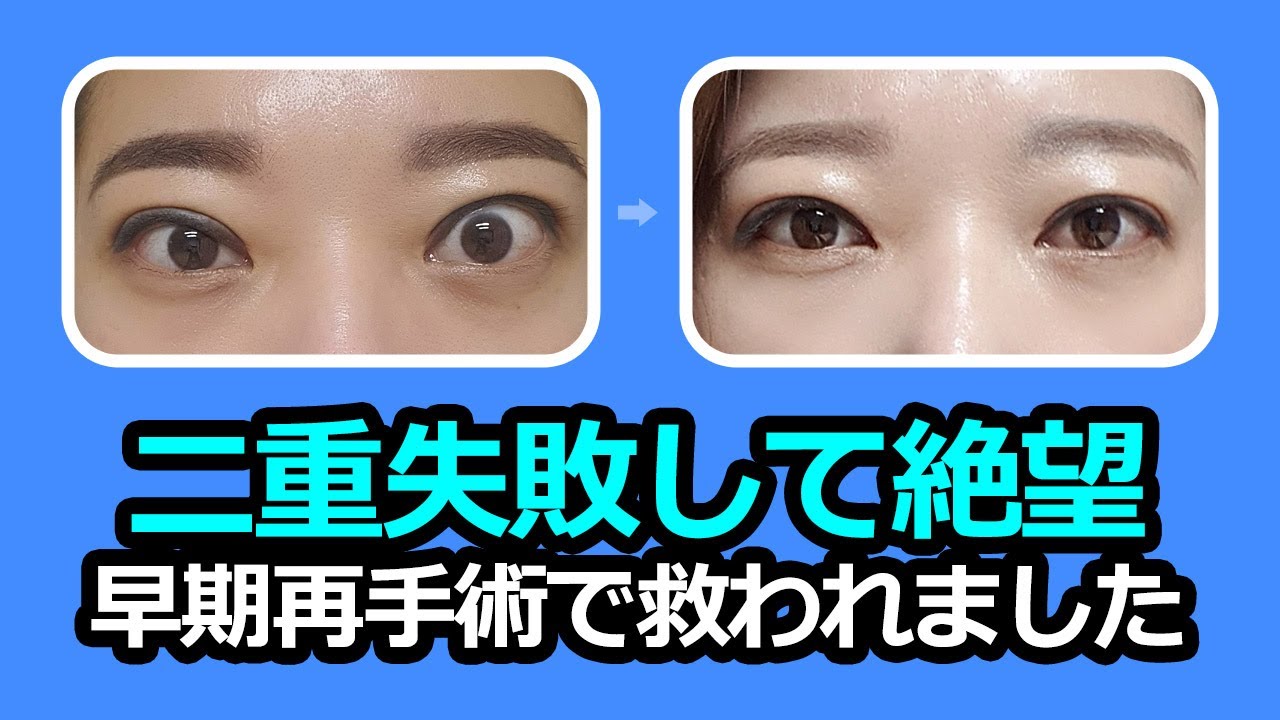 【韓国二重整形】二重整形失敗で絶望、早期再手術で修正した症例