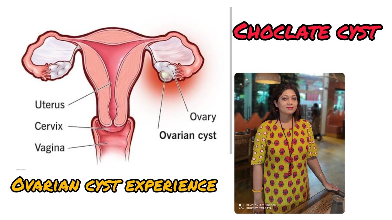 My chocolate cyst story, symptoms & cure YouTube
