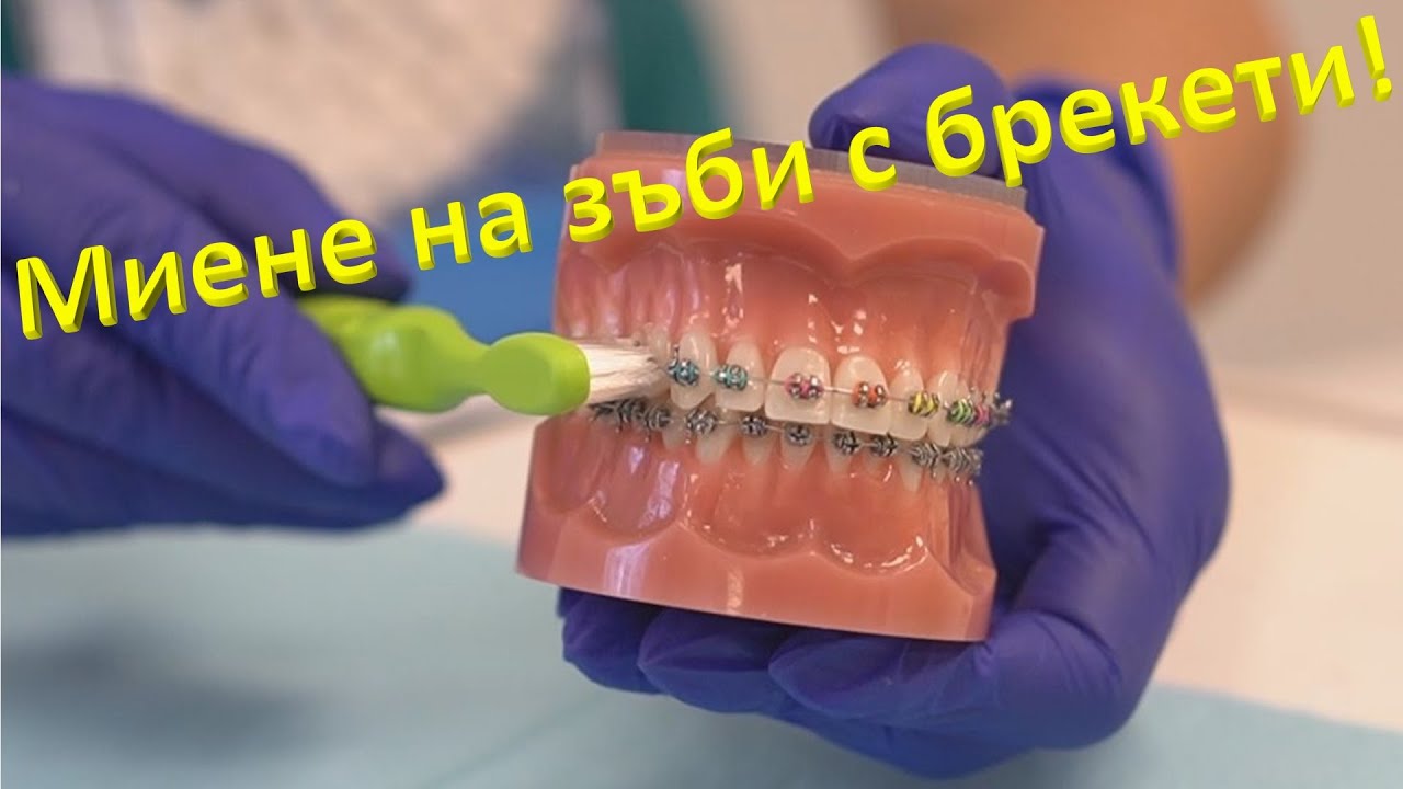 Устна хигиена с брекети! Какво ви очаква, когато имате брекети?
