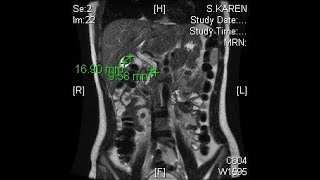 RUQ Pain for 2 weeks in 16 y.o. Girl