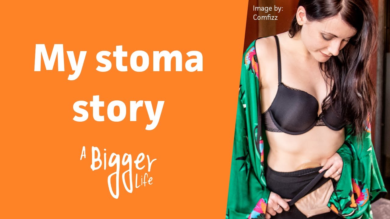 Amy's stoma story - My journey with Crohn's
