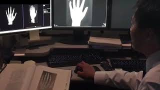 Bone Age Assessment with Artificial Intelligence at MGH