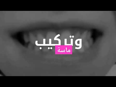 حالة تنظيف وتلميع أسنان مع د أريج محجوب