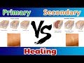 Primary healing Vs Secondary Healing ( Clear Explain )