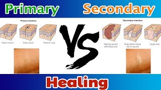 Primary healing Vs Secondary Healing ( Clear Explain )