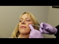 A Live VOLUMA® Treatment, With Instantly Visible Results