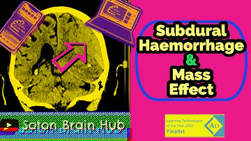 Subdural Haemorrhage and Mass Effect