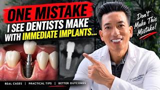 Immediate Dental Implants: The #1 Mistake Dentists Should Avoid