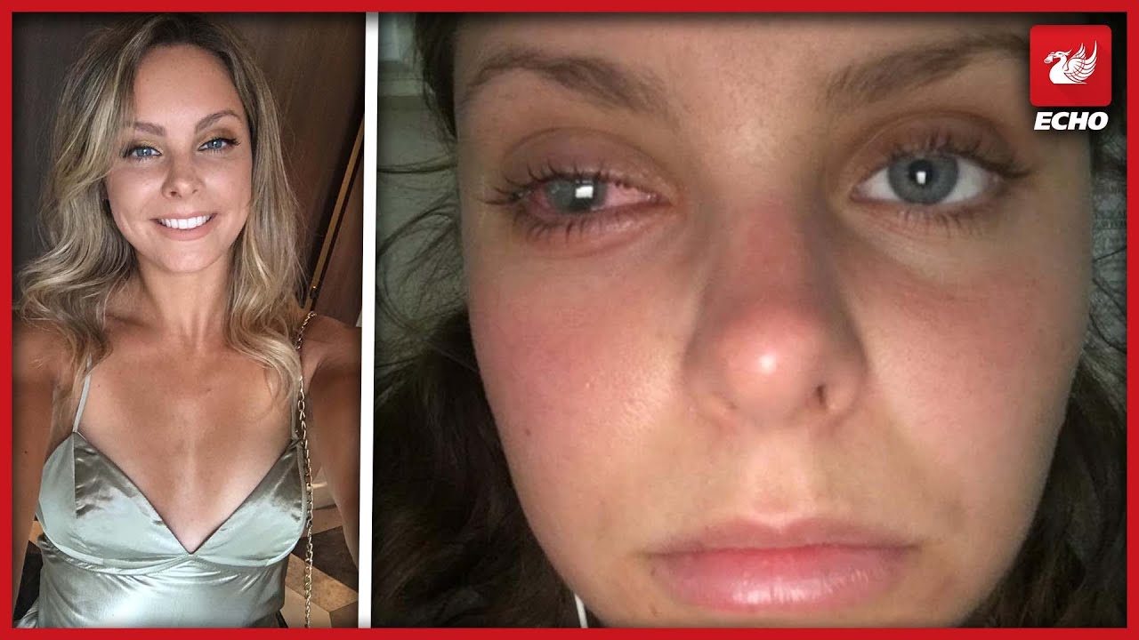 Personal trainer left partially blind after make up bag blunder