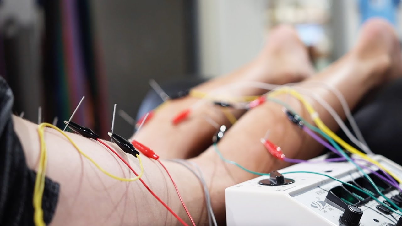 INTRAMUSCULAR ELECTRICAL STIMULATION