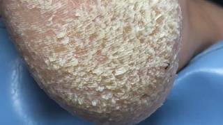 How to get a clean foot?
