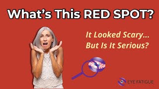 Popped Blood Vessel In Eye Heres What It Means  What To Do