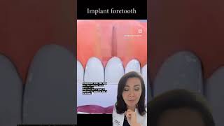How Are Dental Implants Done