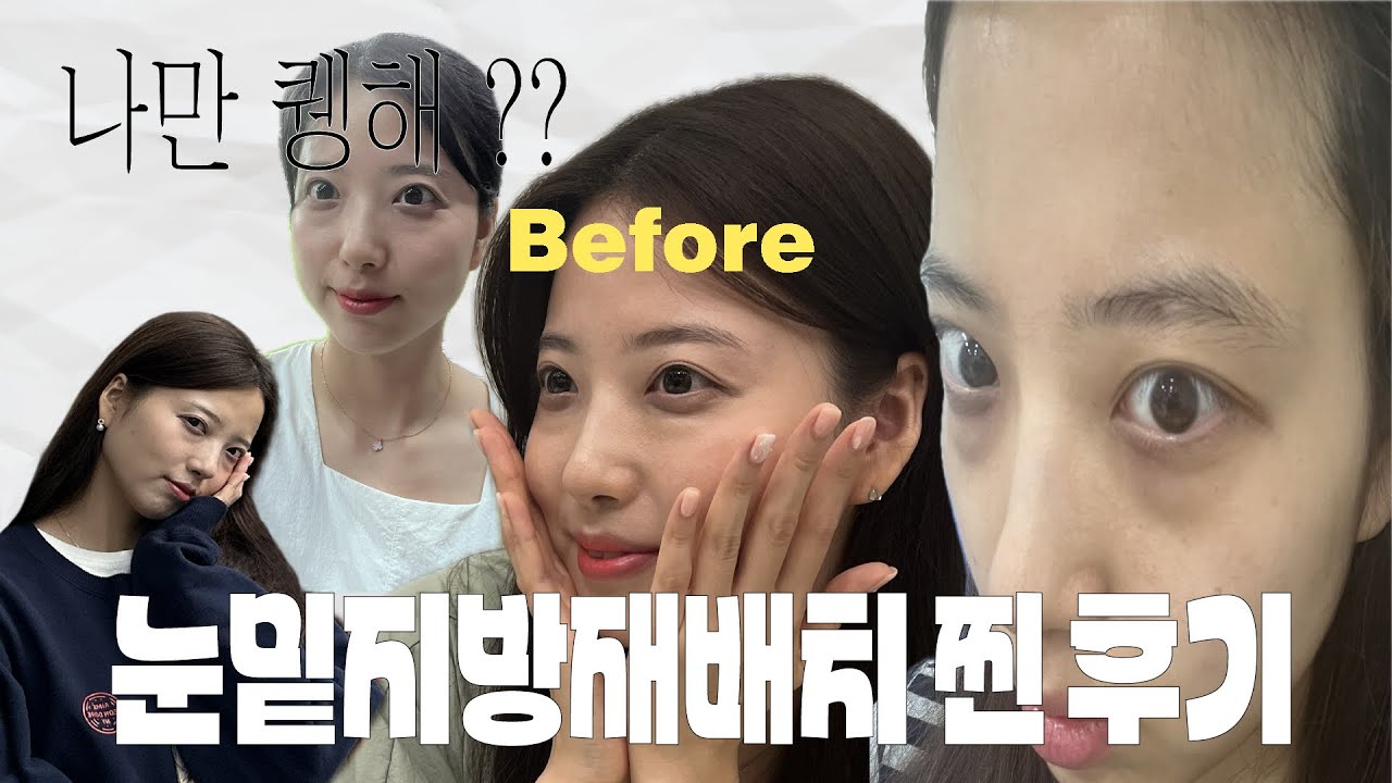 눈밑지방재배치+지방이식 부작용❓실명?피눈물🩸1달차 후기까지 / 겁쟁이의 고민들