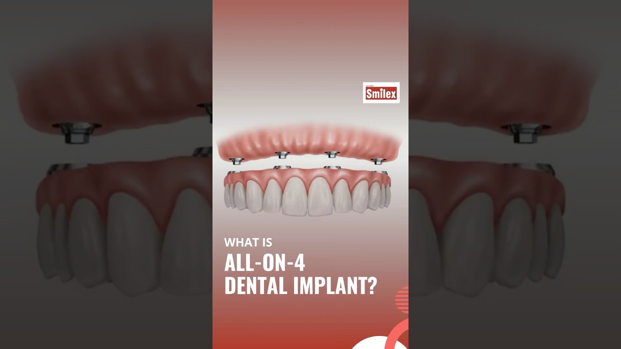 Fixed Teeth in Just 72 Hours? | Pune’s Trusted All-on-4 Implant Expert | Smilex Dental Care