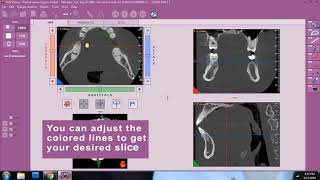 Insights Diagnostic - iRys Software Tutorial Video - Viewing MPR Tab Profile