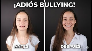 CARILLAS EN TURQUÍA | ¿Valen $8000? Mi Transformación Dental