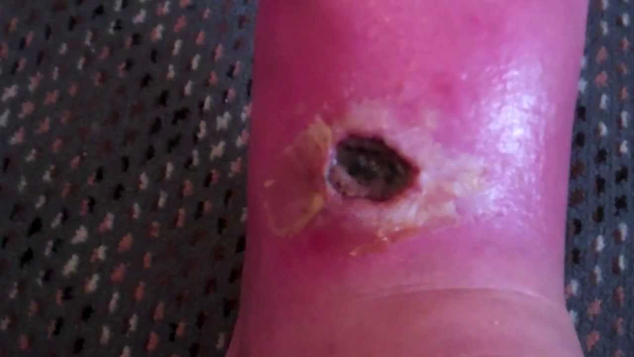 Spider Bite Wound After Five Months-Brown Recluse Spider Bite-Raw - YouTube