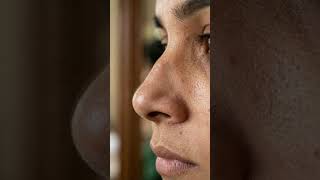 Rhinoplasty Surgery: Nose Reshaping for Better Facial Balance