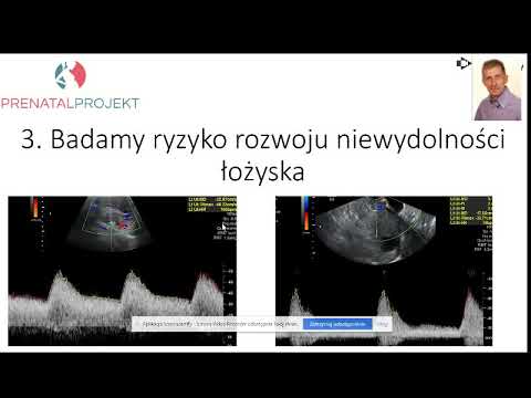 Video: Nenormalni Profili DNK V Plazmi Pri Zgodnjem Raku Jajčnikov Z Uporabo Neinvazivne Prenatalne Platforme Za Testiranje: Posledice Za Presejalno Testiranje Raka