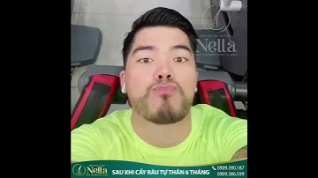 TRƯỚC VÀ SAU KHI CẤY RÂU TỰ THÂN TẠI NELLA