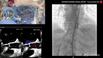 TAVI Using Navitor 25mm SEV