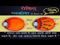 Glaucoma |पेशन्ट जानकारी और जागरूकता | Hindi | What is it, Causes, Warning Signs, Risks, Treatment??