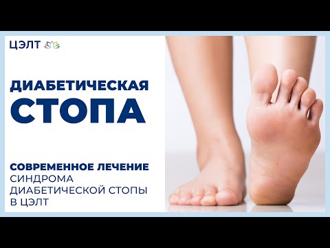 Диабетическая стопа. 👣 Современное лечение синдрома диабетической стопы в ЦЭЛТ