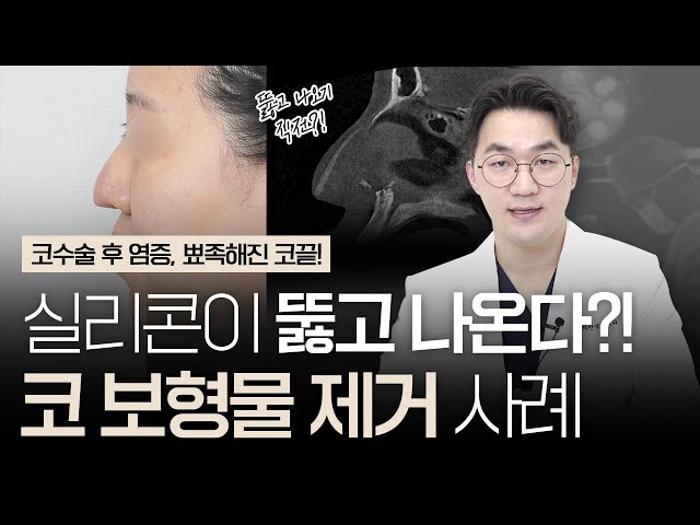 코수술 후 염증으로 빨개지고 뾰족해진 코끝｜실리콘이 뚫고 나오기 직전?! 😮｜코보형물제거 사례