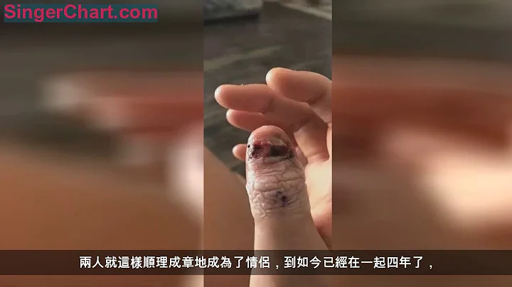 因为喜欢咬指甲，最后她被迫截掉了手指... - 天天要闻