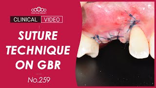 Suture technique on GBR - [Dr. Kim Jaeyoon]