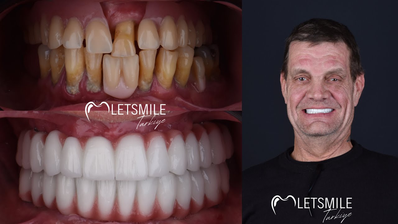 All on Four Implant Treatment TURKEY | ANTALYA