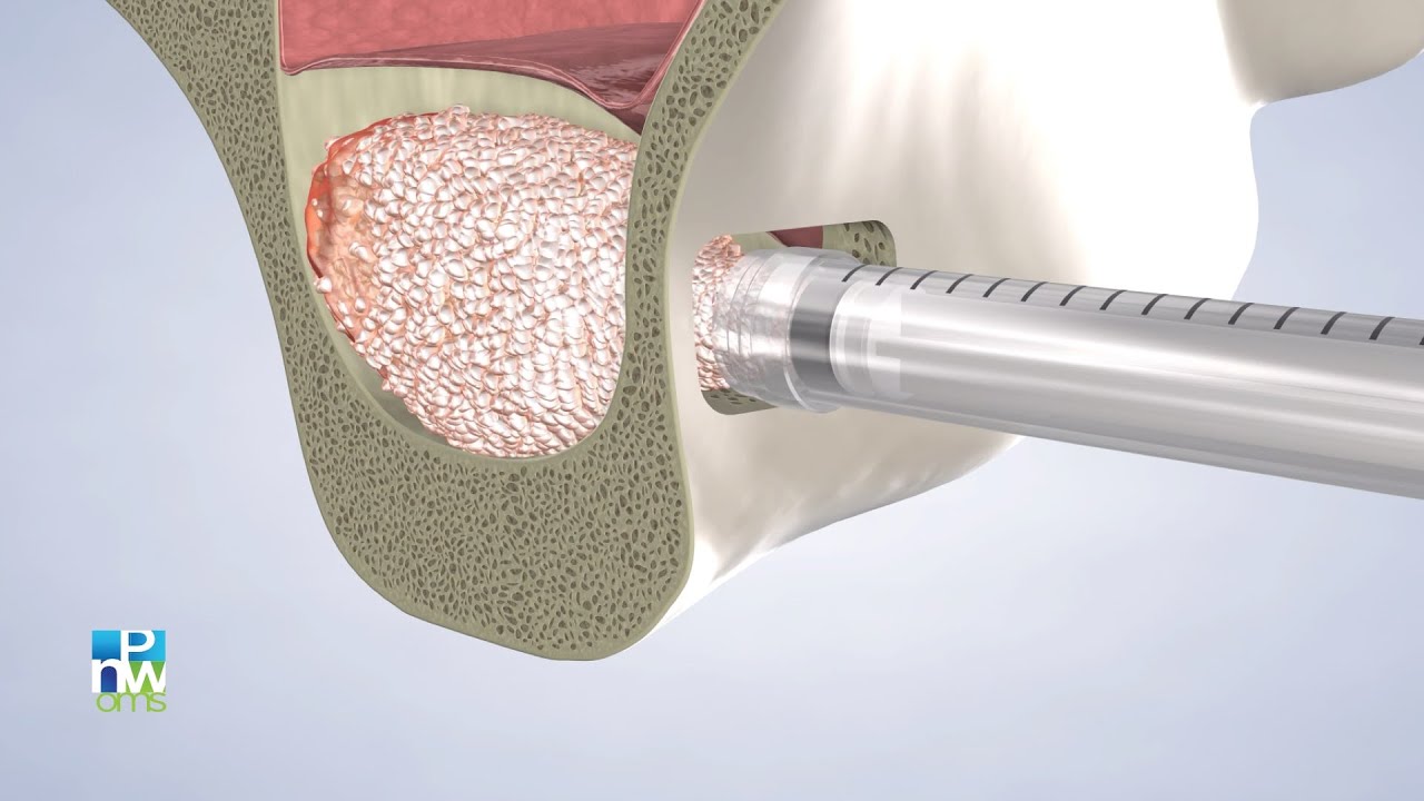 Post-Operative Instructions: Bone Graft/Sinus Lift | Pacific Northwest Oral & Maxillofacial Surgeons