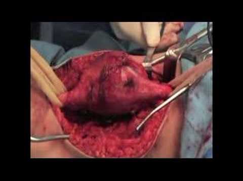 Sciatic Schwannoma Peripheral Nerve Sheath