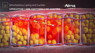 Liposuction, Skin Tightening & Fat Grafting  Lipo Life by Alma Lasers (Medical Device 3D Animation)
