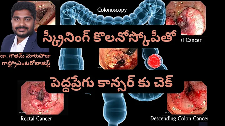 Screening Colonoscopy for Colorectal Cancer | March - Colorectal Cancer Awareness Month