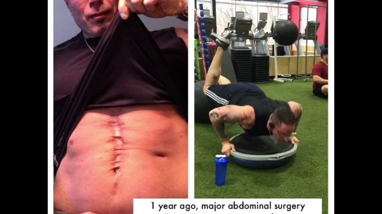 Strong core after major abdominal surgery YouTube