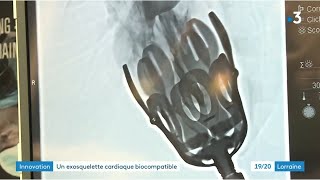 Lexosquelette Cardiaque - Dispositif Dassistance Ventriculaire Par Compression Externe - France 3