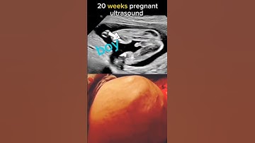 20 week pregnancy ultrasound scan it