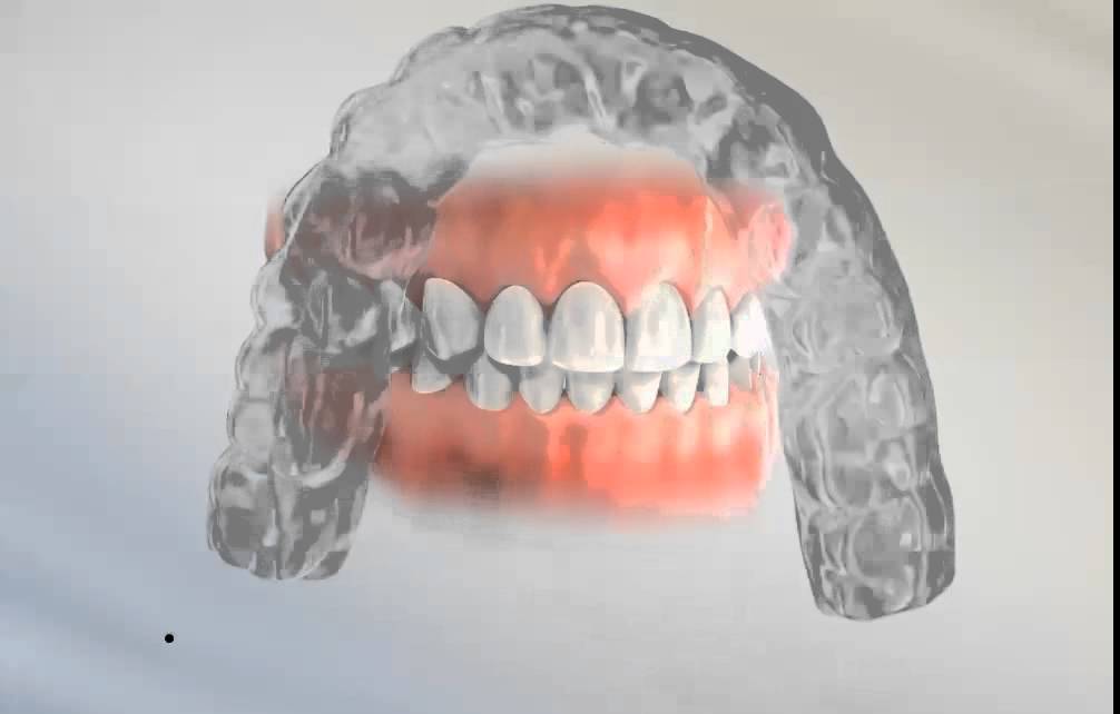 Types of orthodontic retainers