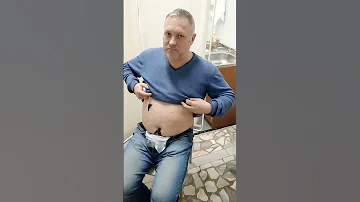 Постановка пиявок в область пупка для лечебного воздействия на печень. #Пиявкидляпечени