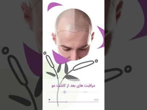 مراقبت های بعد از کاشت مو