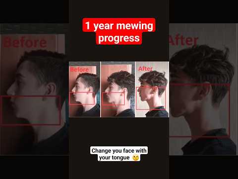 1 year mewing results 💓