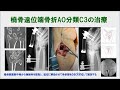 9分19秒）橈骨遠位端骨折AO分類C3の治療